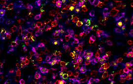 Lymph Node – Anaplastic Large Cell Lymphoma: CD8, FoxP3, CD3, CD4 20x